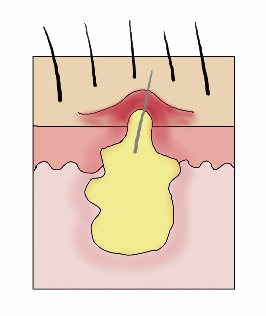 Hautunreinheiten: Entzündung der Talgdrüse
